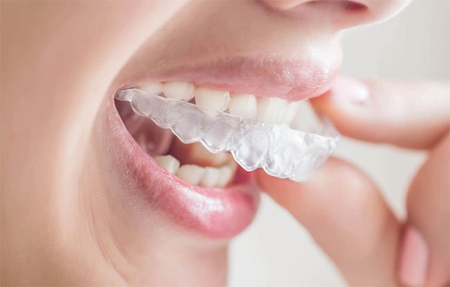 The straight scoop: Choosing between traditional braces and Invisalign «  Smiles by White