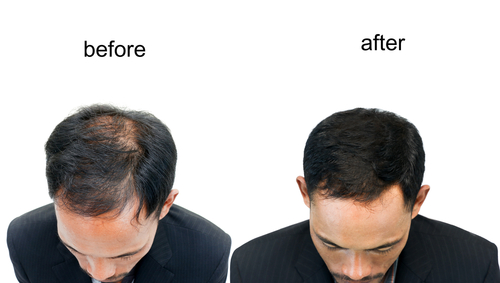 getting a hair transplant in Turkey