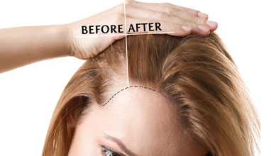 Advantages Of Getting Hair Transplant In Turkey