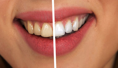 Teeth Whitening and Invisalign - Gaining Self-Esteem through Cosmetic Dentistry