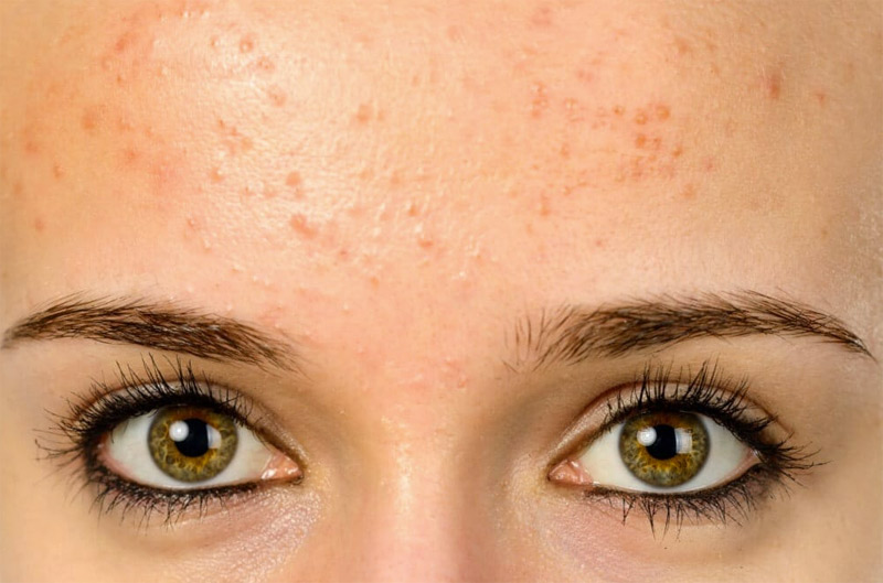 Everything You Need To Know About Fungal Acne How To Cure It Quickly