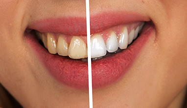 Ways To Get Your Teeth White - The Ultimate Guide