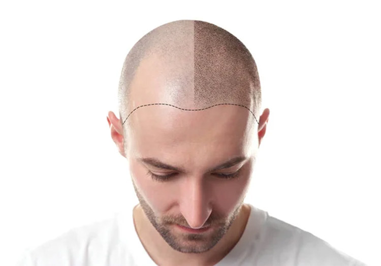 Scalp Pigmentation in Los Angeles: Trendsetting Hair Solution