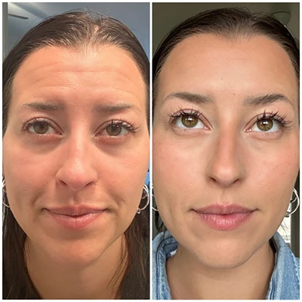 Microneedling